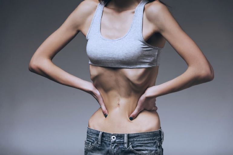 Anoreksiya Nervoza Nedir ?